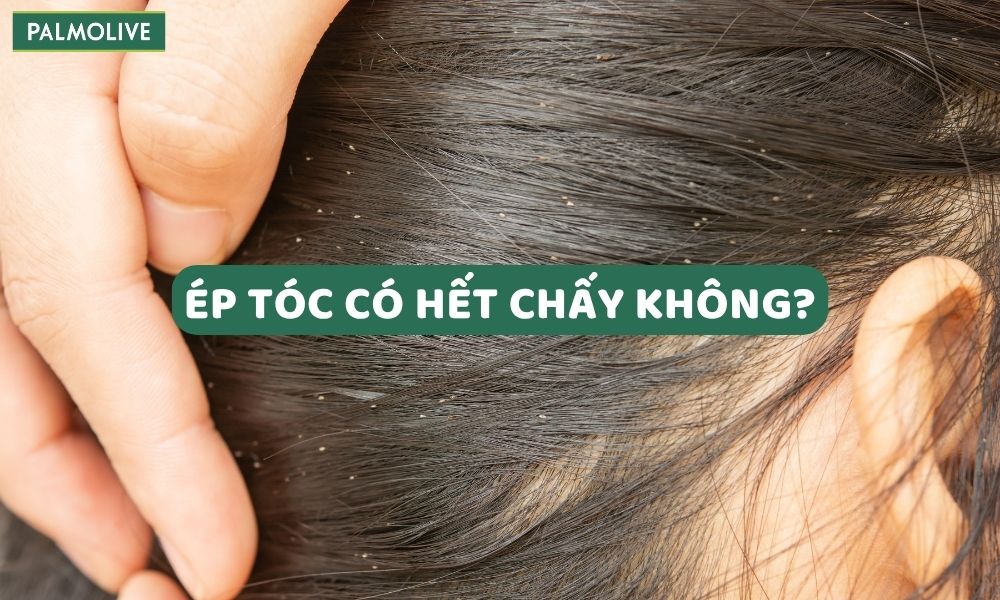 Ép tóc có hết chấy không? 15 cách trị chấy tại nhà hiệu quả, nhanh chóng