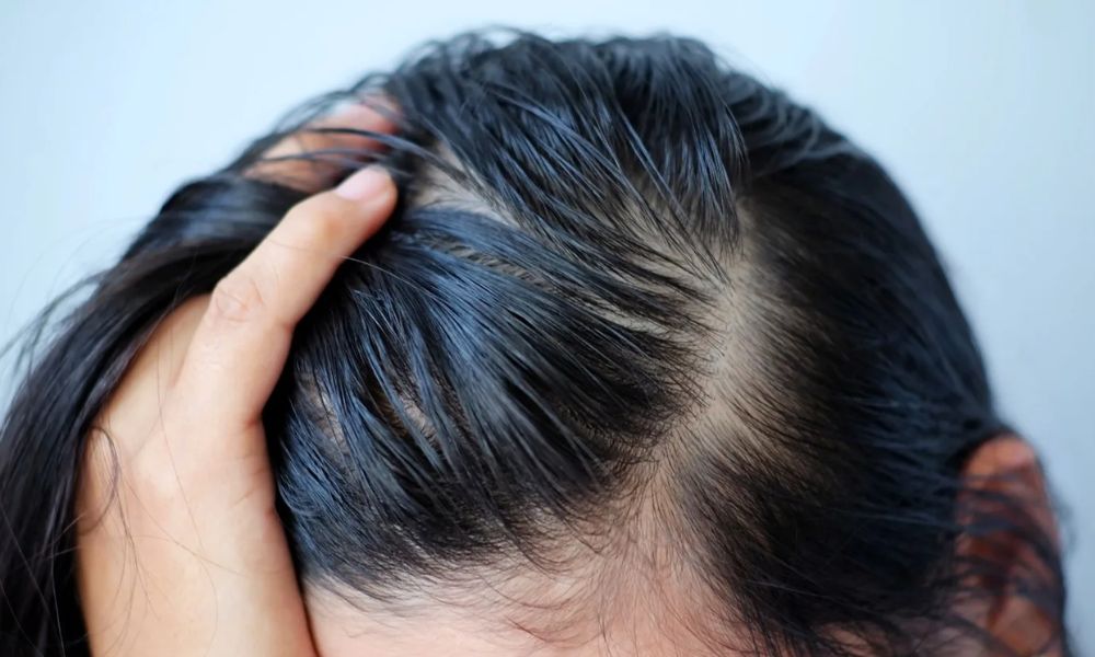 Bết tóc do thường xuyên chạm vào tóc