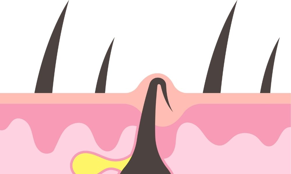 Nhổ tóc bạc là nguyên nhân khiến tóc mọc lệch hướng và đâm vào trong da