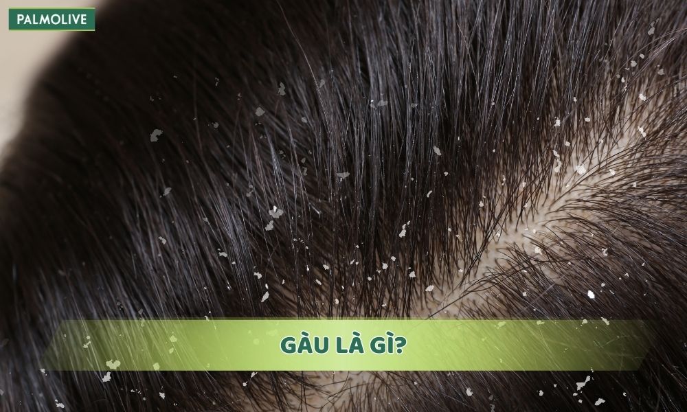 Gàu là hiện tượng da đầu bong vảy trắng hoặc vàng, gây ngứa và khó chịu