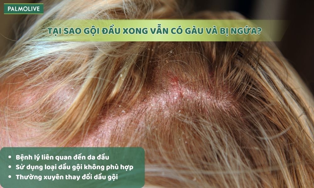 Thường xuyên thay đổi dầu gội khiến da đầu không kịp thích nghi, dễ bị kích ứng